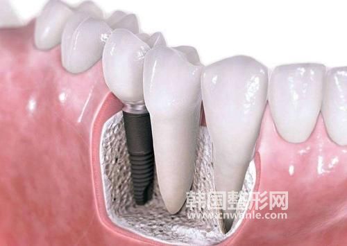 <a href='/tag_zhongzhiya27.html'>種植牙</a>一顆多少錢?