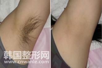 冰點<a href='/tag_tuomao16.html'>脫毛</a>脫腋毛疼嗎 皮膚黑會很疼對嗎？