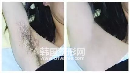 冰點(diǎn)<a href='/tag_tuomao16.html'>脫毛</a>