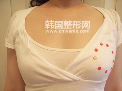 <a href='/tag_jiati95.html'>假體</a>豐胸有什么副作用?