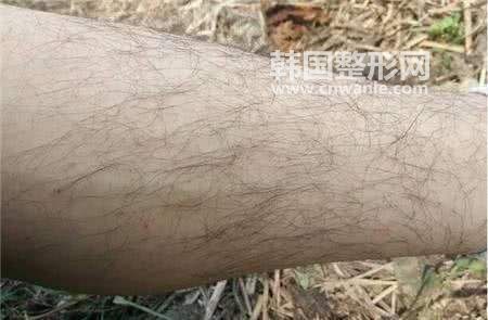 　　無論男女身體上長出一些多余的體毛這是很正常的現(xiàn)象，一般來說，男性朋友們的體毛要比女性朋友們的多一些。由于激素分泌男性朋友們體毛旺盛一點，留個胡子，比較符合男性朋友們的氣質(zhì)，這樣子顯得有男人味兒。但是女性朋友們體毛多一點，就有點不好看雅觀了，這樣就需要做<a href='/tag_tuomaoshoushu2.html'>脫毛手術(shù)</a>了，隨著科技的發(fā)展，脫毛也不需要用刮胡刀剃毛了，在這里我給大家介紹一種新的無痛脫毛技術(shù)。 　　無痛脫毛有什么優(yōu)勢？ 　　一、獨創(chuàng)技術(shù)，真正無痛。冰點無痛脫毛激光是第三代的脫毛激光產(chǎn)品，全新的雙脈沖模式保證了在加熱破壞毛囊的同時不會產(chǎn)生熱損傷，不會出現(xiàn)過熱反應(yīng)，整個過程可以在幾乎無痛的狀態(tài)下進行。脫毛再也沒有什么痛苦可言，真正無痛脫毛，讓女性朋友們告別體毛煩惱。 　　二、冰點舒適，冰爽體驗。冰點無痛脫毛激光只要將毛囊周圍組織加熱到四十?dāng)z氏度，毛囊溫度升高到四十五攝氏度后持續(xù)很短的時間即可脫除毛發(fā)，在這個過程中由于優(yōu)良的冷卻技術(shù)，激光寶石窗口的溫度保持在四攝氏度左右，而表皮的溫度始終被控制在二十五攝氏度，所以我們感受到的只有陣陣舒適，涼爽舒適，讓脫毛不再是痛苦，成為一種享受。 　　三、安全高效，肌膚光潔動人。冰點無痛脫毛激光采用標(biāo)準(zhǔn)的脫毛波長，可以保證高效的毛發(fā)脫除，這種脫毛方法經(jīng)過，已經(jīng)成為美麗達(dá)人的首選，可以使肌膚更加光潔動人，真正零痛苦，零風(fēng)險，高效率。
