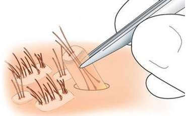 <a href='/tag_maofayizhi6.html'>毛發(fā)移植</a>術(shù)好不好？有什么副作用嗎？