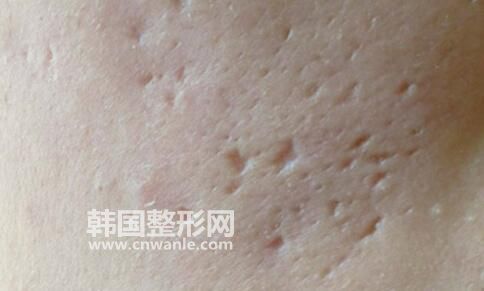 凹陷性<a href='/tag_bahen21.html'>疤痕</a>的分類到底有幾種