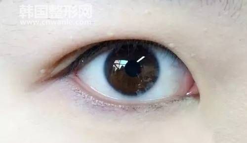 <a href='/tag_neishuangyanpi2.html'>內(nèi)雙眼皮</a>圖