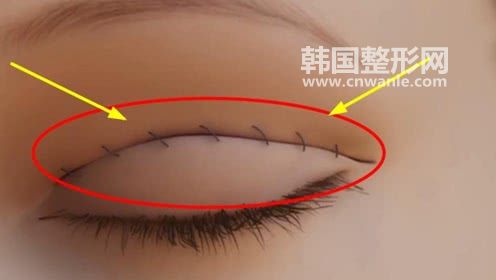 做完<a href='/tag_shuangyan108.html'>雙眼</a>皮術(shù)后恢復(fù)過程圖