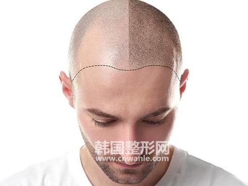 <a href='/tag_maofayizhi6.html'>毛發(fā)移植</a>術(shù)對身體有什么危害?