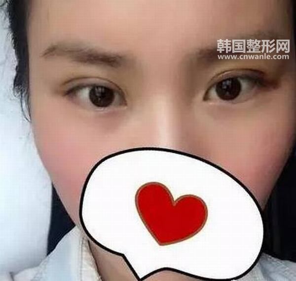 <a href='/tag_hanshisandian8.html'>韓式三點(diǎn)</a>無(wú)痛<a href='/tag_shuangyan108.html'>雙眼</a>皮效果怎么樣?