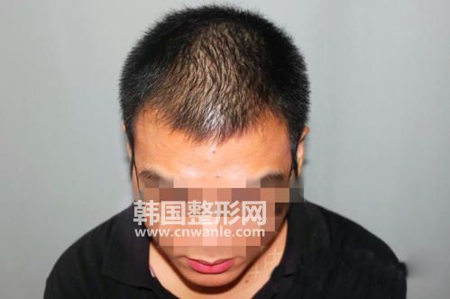 <a href='/tag_maofayizhi6.html'>毛發(fā)移植</a>手術(shù)后為什么要經(jīng)歷脫落期，以后還會掉嗎？