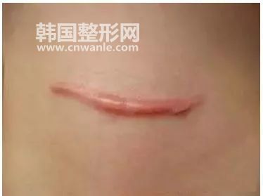修復(fù)手術(shù)<a href='/tag_bahen21.html'>疤痕</a>的方法？