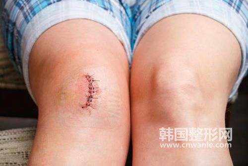 修復(fù)手術(shù)<a href='/tag_bahen21.html'>疤痕</a>的藥膏?
