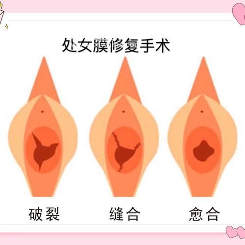 韓國(guó)微創(chuàng)整形<a href='/tag_chunvmo16.html'>處女膜</a>修復(fù)術(shù)讓女人更自信