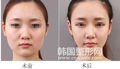面部<a href='/tag_xizhi74.html'>吸脂</a>后遺癥有哪些?