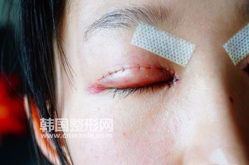 請問做<a href='/tag_maixian35.html'>埋線</a><a href='/tag_shuangyan108.html'>雙眼</a>皮注意事項有哪些?