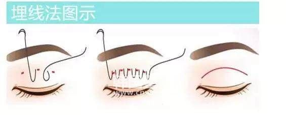 <a href='/tag_maixianshuangyanpi15.html'>埋線雙眼皮</a>和全<a href='/tag_qieshuangyanpi3.html'>切雙眼皮</a>的區(qū)別