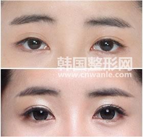 <a href='/tag_kaiwaiyanjiao4.html'>開外眼角</a><a href='/tag_qianhouduibi.html'>前后對比</a>照圖片