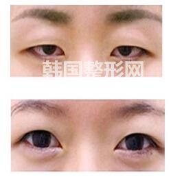 開外眼角前后對比照圖片