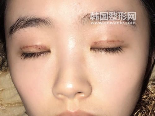 <a href='/tag_maixian35.html'>埋線</a><a href='/tag_shuangyan108.html'>雙眼</a>皮適合按些人群？