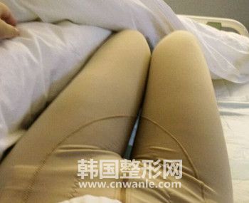 抽脂一定要穿塑身褲嗎？