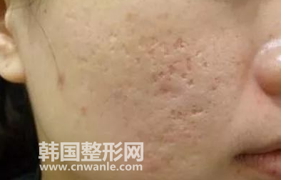微針去<a href='/tag_doukeng4.html'>痘坑</a>要治療幾次?