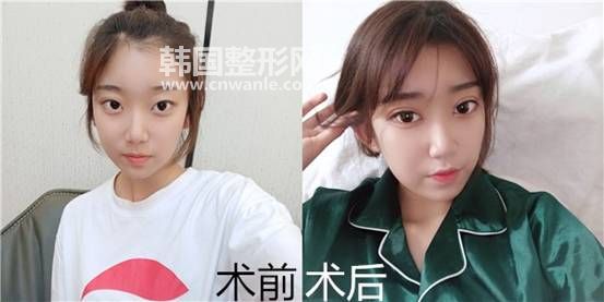 <a href='/tag_maixian35.html'>埋線</a><a href='/tag_shuangyan108.html'>雙眼</a>皮手術(shù)需要多長(zhǎng)時(shí)間、恢復(fù)需要多久？