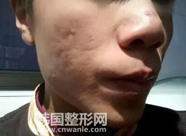 目前做微針<a href='/tag_zhidou3.html'>治痘</a>坑多少錢一次？