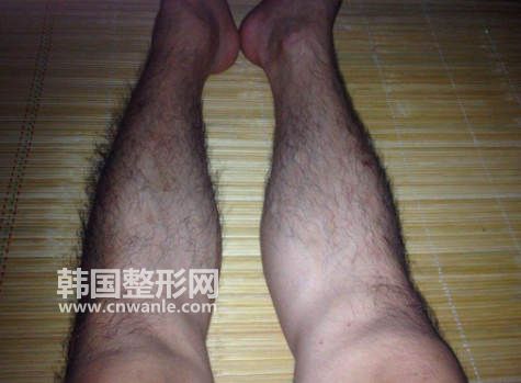 激光<a href='/tag_tuomao16.html'>脫毛</a>后還會(huì)不會(huì)再長?