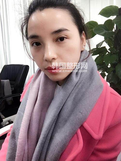 北京八大處割<a href='/tag_shuangyan108.html'>雙眼</a>皮有哪些方式？多少錢(qián)？