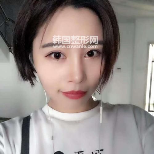 <a href='/tag_maixian35.html'>埋線(xiàn)</a><a href='/tag_shuangyan108.html'>雙眼</a>皮效果圖 埋線(xiàn)<a href='/tag_shuangyanpi53.html'>雙眼皮</a>能保持多久