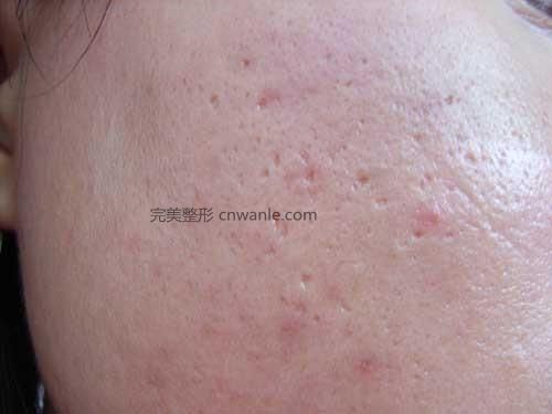 點陣激光祛<a href='/tag_douyin2.html'>痘印</a>有什么效果優(yōu)勢？