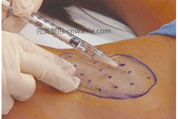 botox除<a href='/tag_yechou4.html'>腋臭</a>效果怎么樣？
