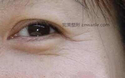 激光<a href='/tag_chuzhou14.html'>除皺</a>可以去除眼角皺紋嗎？