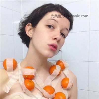 激光去<a href='/tag_huangheban58.html'>黃褐斑</a>多久恢復(fù)？如何預(yù)防黃褐斑產(chǎn)生？