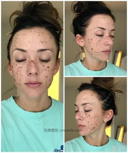 激光怎么祛老年斑的原理?