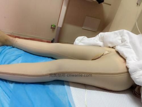 劉存琳<a href='/tag_datui21.html'>大腿</a><a href='/tag_xizhi74.html'>吸脂</a>反彈嗎？