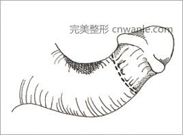 <a href='/tag_yinjingzengcu.html'>陰莖增粗</a>術(shù)是什么?適合哪些人群?