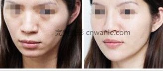 <a href='/tag_boniaosuantianchong7.html'>玻尿酸填充</a>面頰