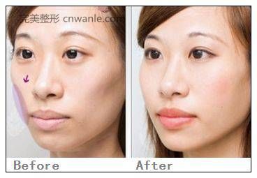 玻尿酸豐面頰的效果怎么樣？