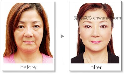 玻尿酸豐臉頰效果好不好