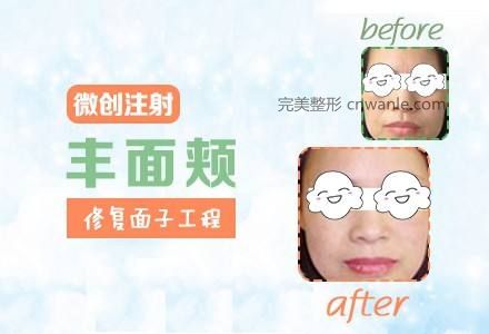 上海做玻尿酸豐面頰效果怎么樣好不好