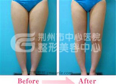 <a href='/tag_datuixizhishu.html'>大腿吸脂術(shù)</a>會(huì)不會(huì)反彈呢?