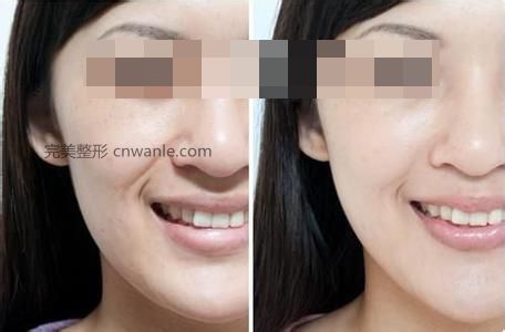 玻尿酸注射豐面頰效果怎么樣