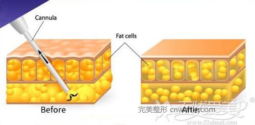 吸脂手術(shù)原理