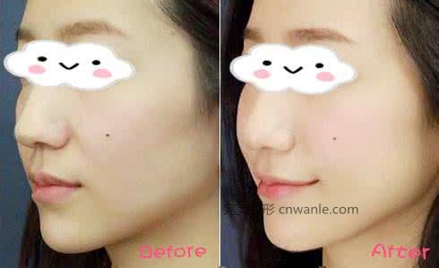 臉部打玻尿酸豐臉頰效果好嗎