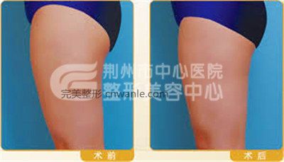 做過大腿吸脂手術(shù)后會(huì)不會(huì)反彈?