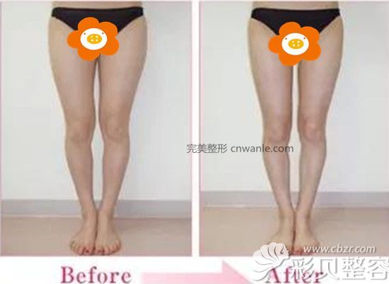 大腿吸脂前后對(duì)比圖