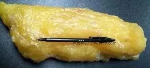 腹部吸脂 腹部吸脂