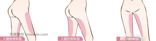 大腿吸脂術(shù)部位展示