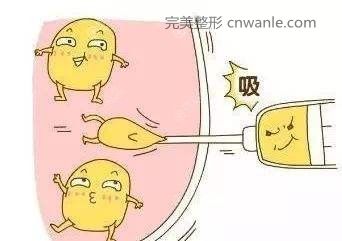 大腿吸脂會不會反彈？
