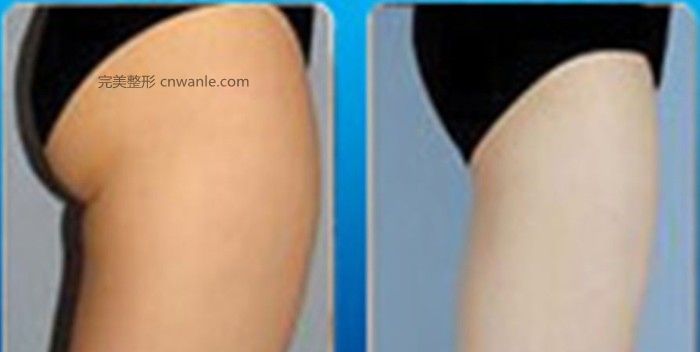 腿部<a href='/tag_xizhisuxing.html'>吸脂塑形</a>術(shù)會反彈嗎