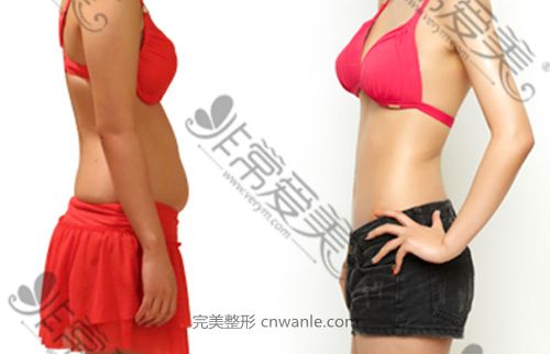 韓國Lyhn診療&整形外科腰腹吸脂案例對比圖